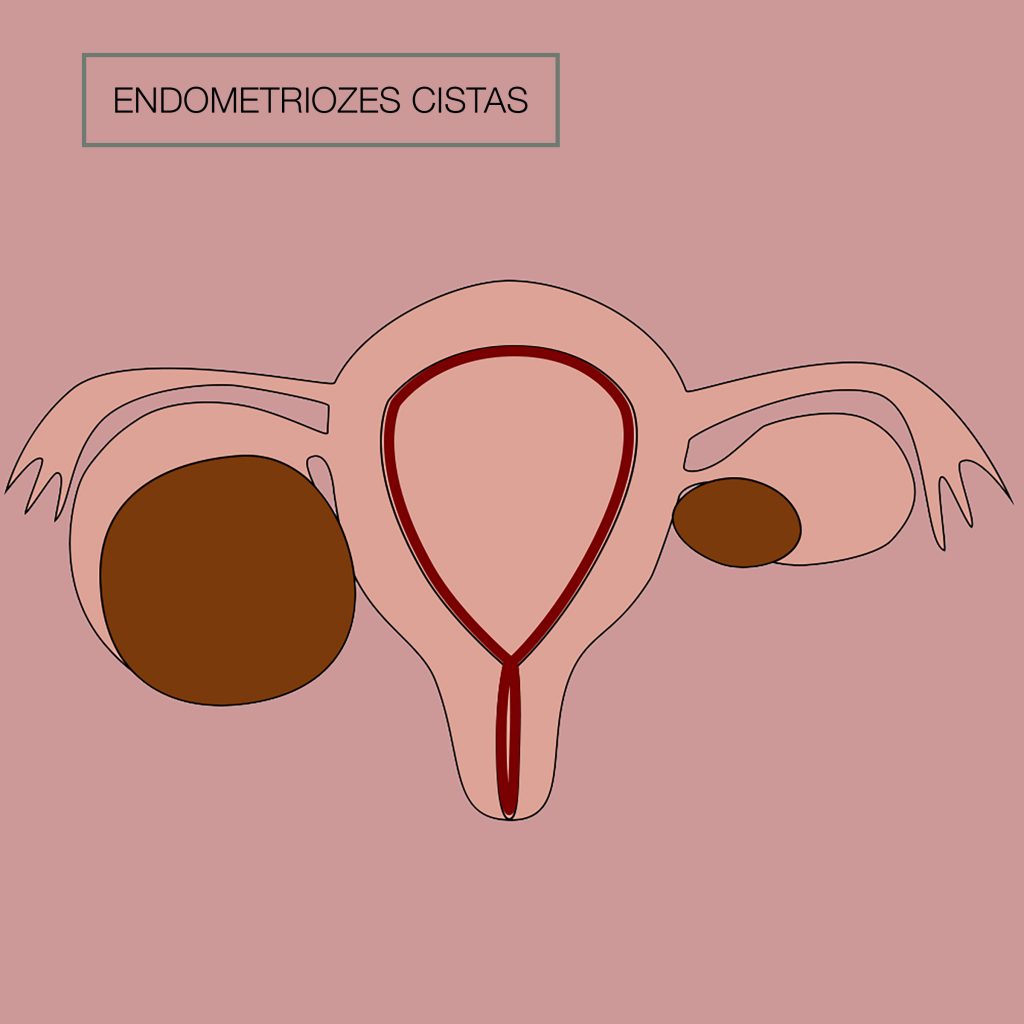 endometriozes cista