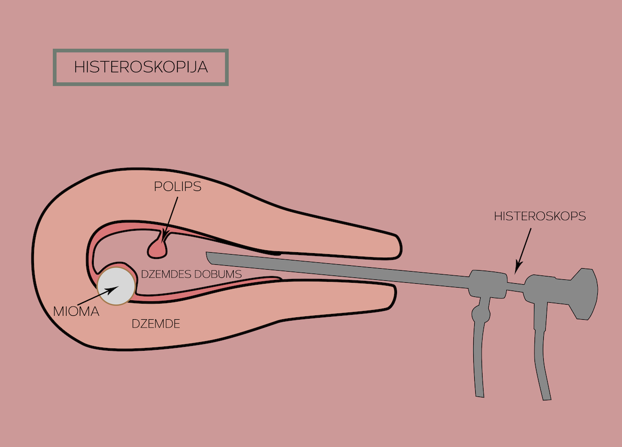 Histeroskopija