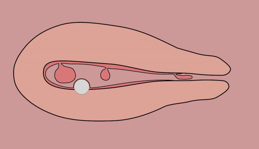 Лечение полипа эндометрия – Клиника женского здоровья Моситалмед