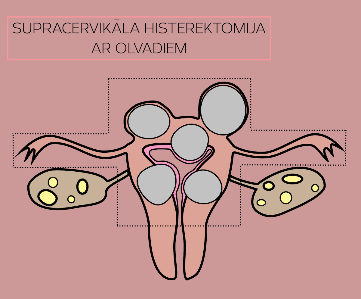 Supracervikāla histerektomija ar olvadiem