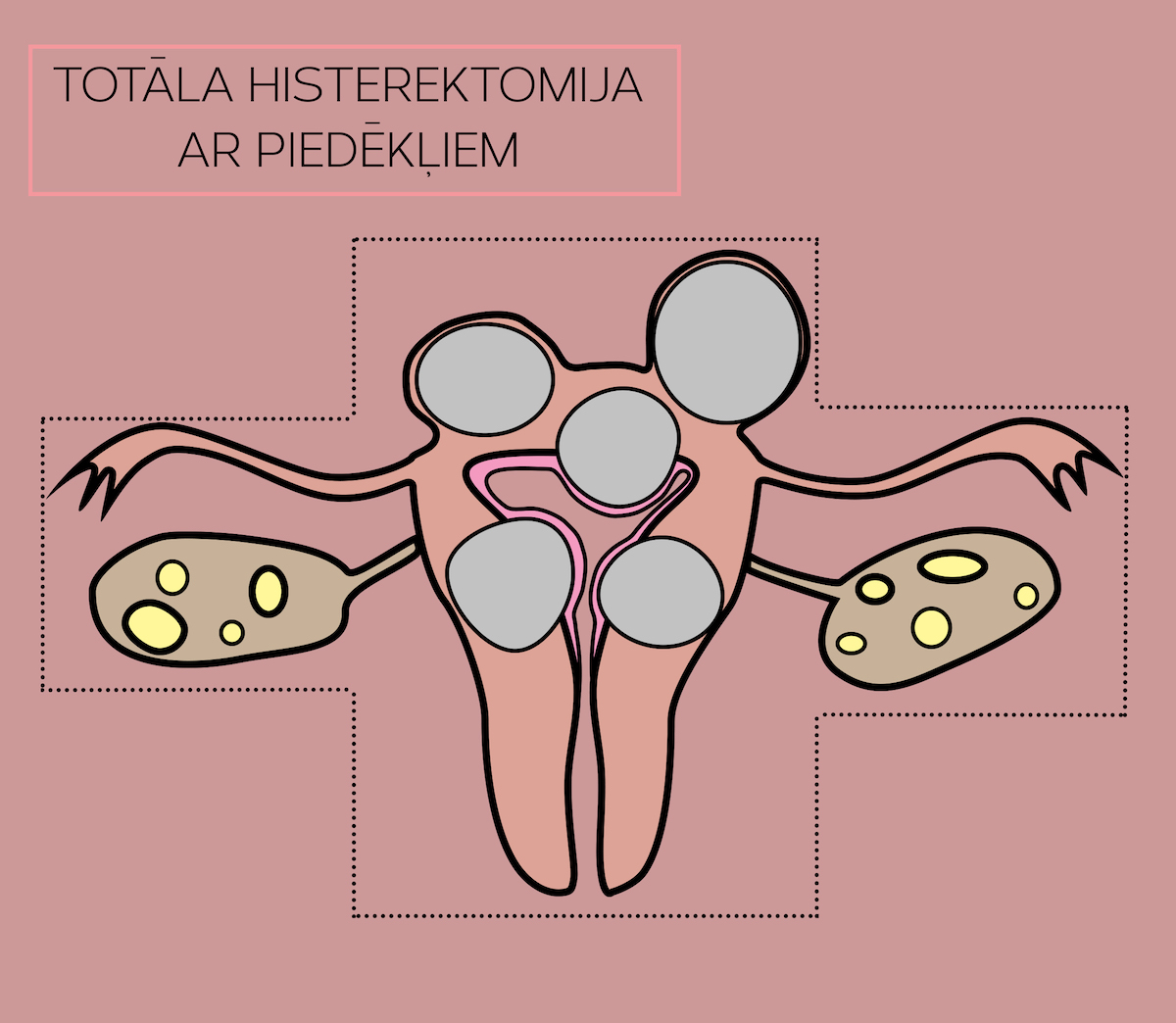 Totāla histerektomija ar piedēkļiem