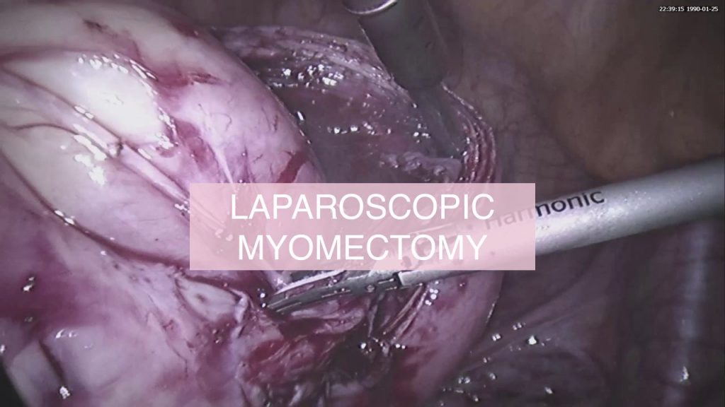 Laparoskopiska miomektomija