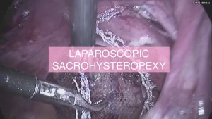 Лапароскопическое лечение выпадения матки и влагалища